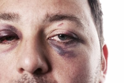 Sports Eye Injuries treatment in Chicago